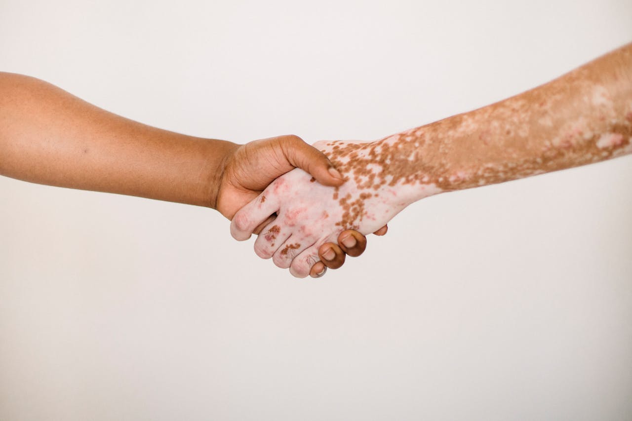 Psoriazisul: Tratamente moderne și strategii de gestionare
